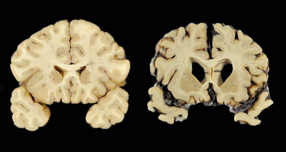 Study: CTE Found In Nearly All Donated NFL Player Brains